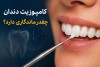 کامپوزیت دندان چقدر ماندگاری دارد؟